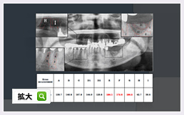 顎骨壊死（ONJ）患者のal-BMD評価症例